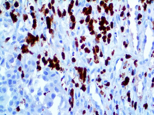 IHC of S100P on an FFPE Melanoma Tissue
